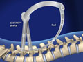 Lumbar Pedicle Screw Fixation (CD Horizon® Sextant®)