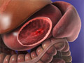 Peptic Ulcer