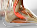 Peroneal Tendonitis
