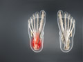Plantar Fasciitis