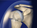 Proximal Humerus Fracture (Broken Shoulder)