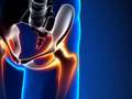 PRP Therapy for Hip Arthritis