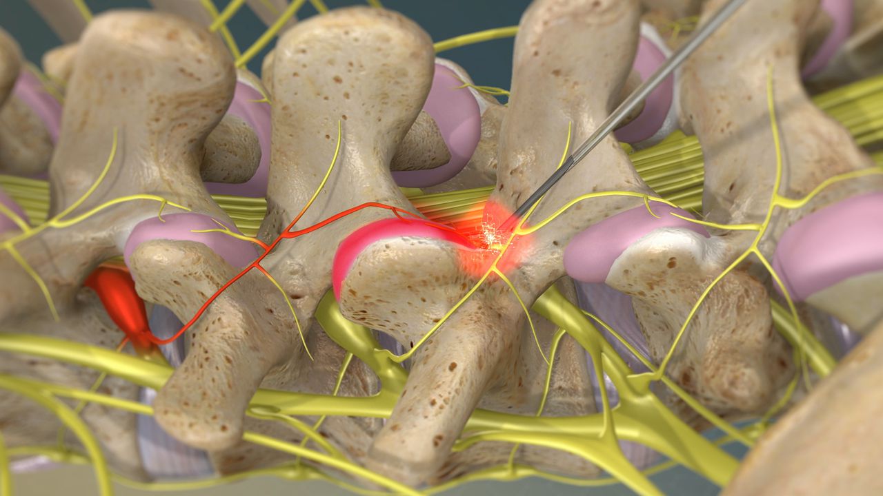 Radiofrequency Neurotomy of the Lumbar Facets
