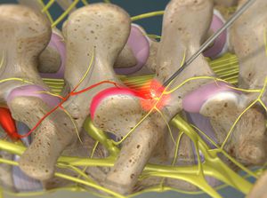 Radiofrequency Neurotomy of the Lumbar Facets