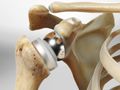 Reverse Total Shoulder Replacement