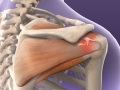 Rotator Cuff Tears