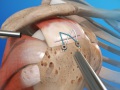 Rotator Cuff Repair (Arthroscopic)