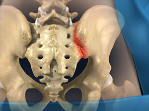 Sacroiliac Joint Steroid Injection video thumbnail