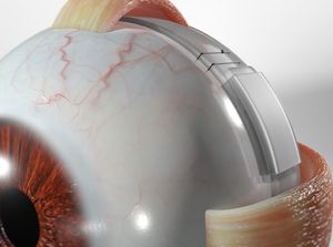 Scleral Buckling educational video provided by Eye Care and Vision Associates, Ophthalmology, Buffalo, NY