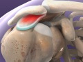 Shoulder Impingement Syndrome