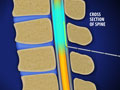 Spinal Epidural for Hip and Lower Extremity