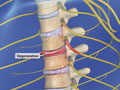 Spinal Stenosis (Thoracic)