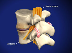 Spondylosis
