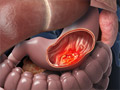 Stomach (Gastric) Cancer