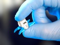  Superion® InterSpinous Spacer (Vertiflex)