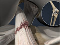 Anterior Cruciate Ligament Tear (ACL Tear)