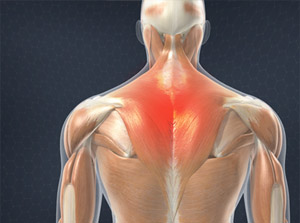 Muscle Strain of the Upper Back (Trapezius Strain) video thumbnail