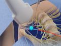 Ultrasound-Guided Ilioinguinal Nerve Block