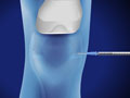 Ultrasound-Guided Injection for Knee Pain