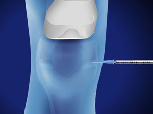 Ultrasound-Guided Injection for Knee Pain