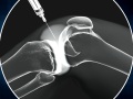 Viscosupplementation for Arthritis of the Knee