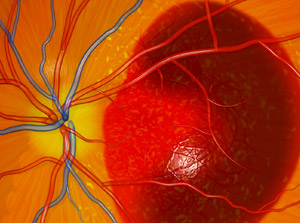 Age-Related Macular Degeneration, Wet Type (Wet AMD) educational video provided by Eye Care and Vision Associates, Ophthalmology, Buffalo, NY