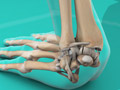 Wrist Sprain